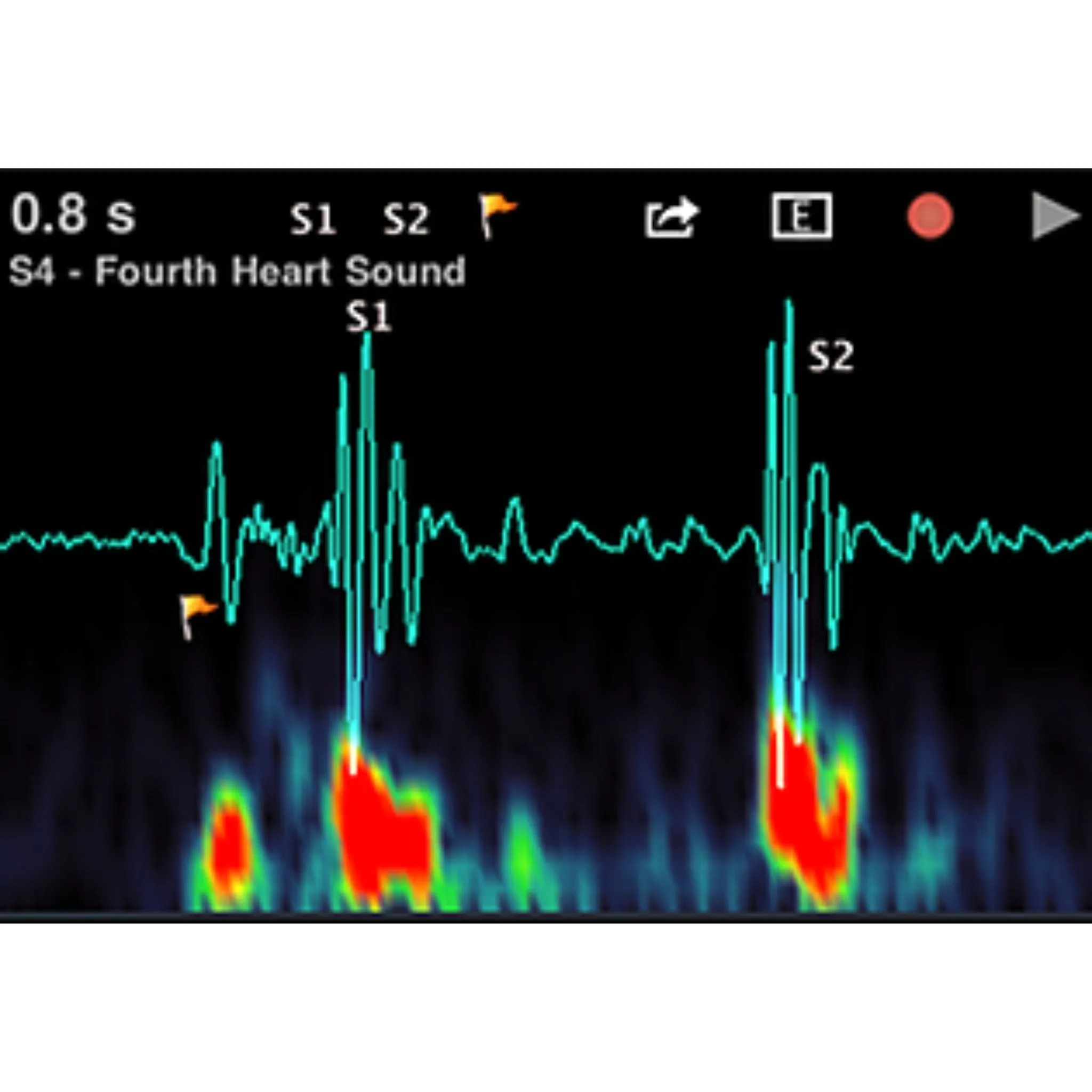 Thinklabs One Stethoscope